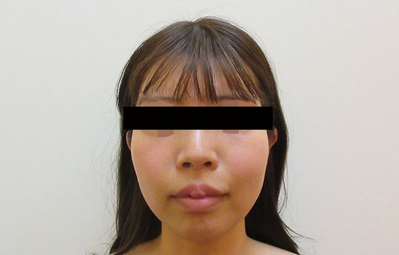 顔の脂肪注入の症例写真一覧