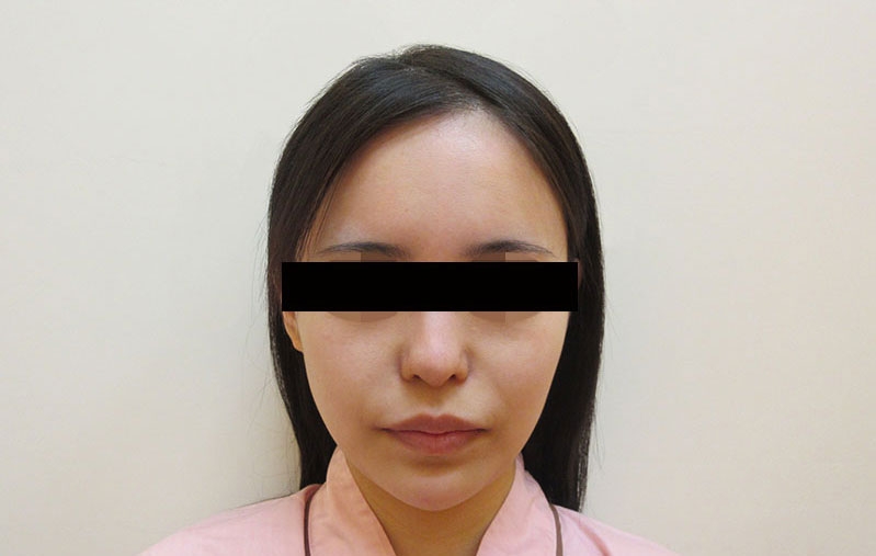 顔の脂肪注入の症例写真一覧