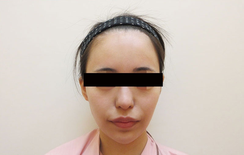 顔の脂肪注入の症例写真一覧