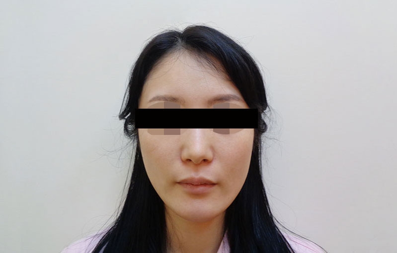 顔の脂肪注入の症例写真一覧