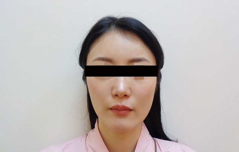 顔の脂肪注入の症例写真一覧