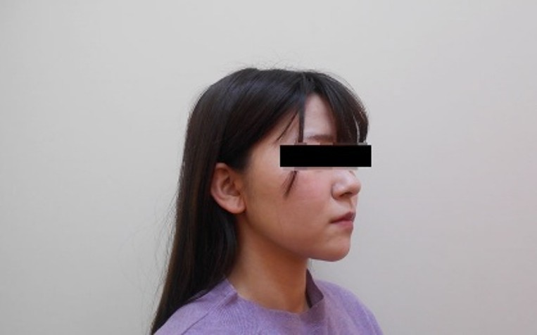 脂肪吸引の症例写真一覧