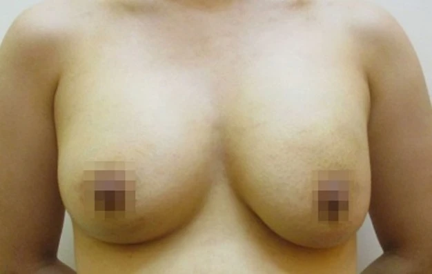 豊胸術の症例写真一覧