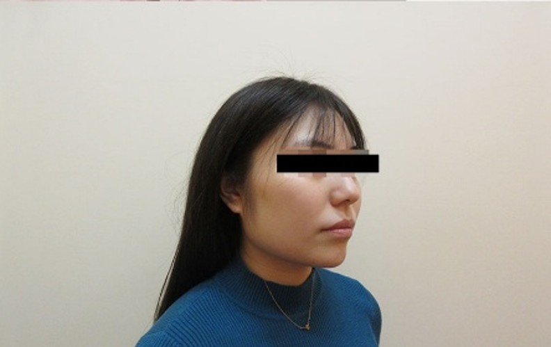 脂肪吸引の症例写真一覧