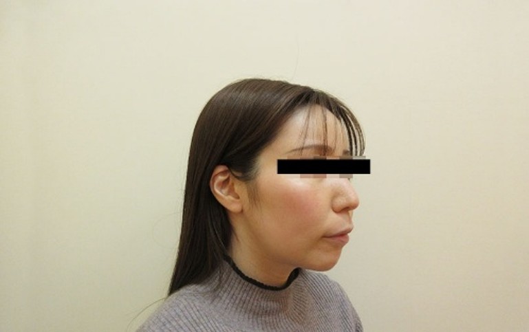 脂肪吸引の症例写真一覧