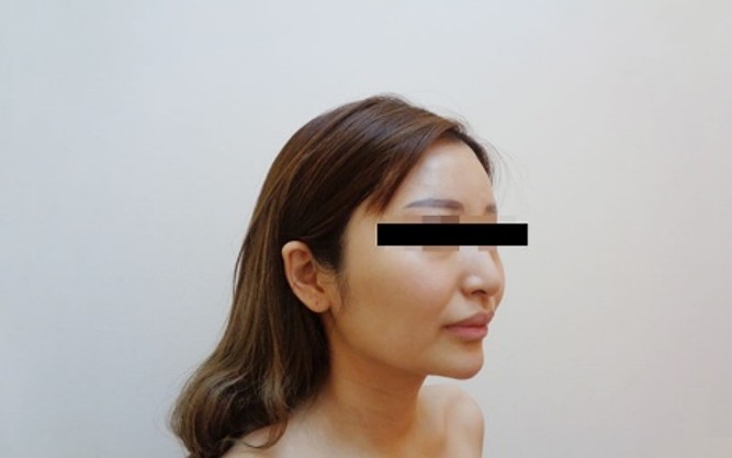 脂肪吸引の症例写真一覧