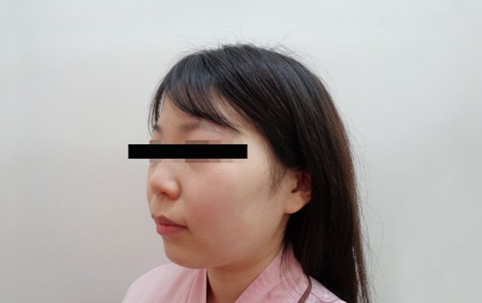 脂肪吸引の症例写真一覧