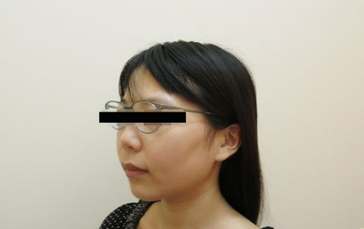 脂肪吸引の症例写真一覧