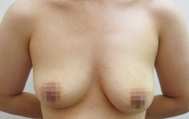 豊胸術の症例写真一覧