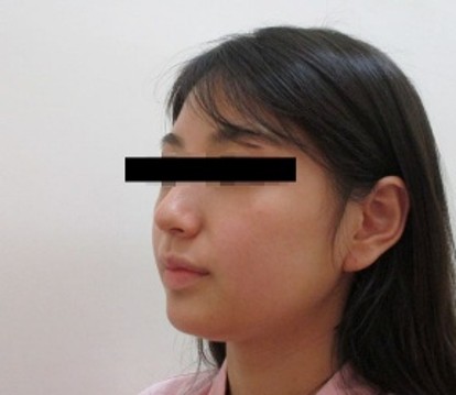 脂肪吸引の症例写真一覧