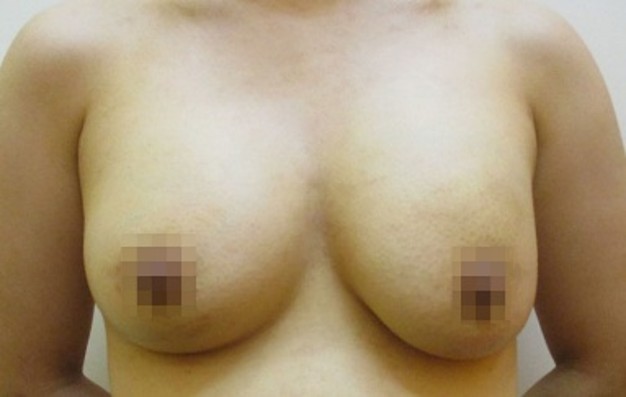 豊胸術の症例写真一覧