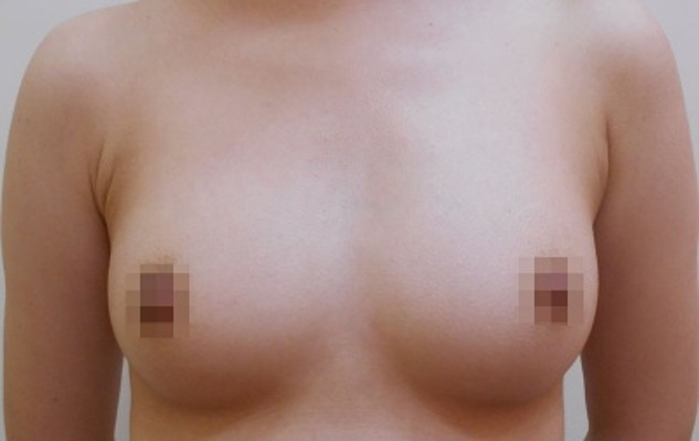 豊胸術の症例写真一覧