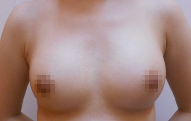 豊胸術の症例写真一覧