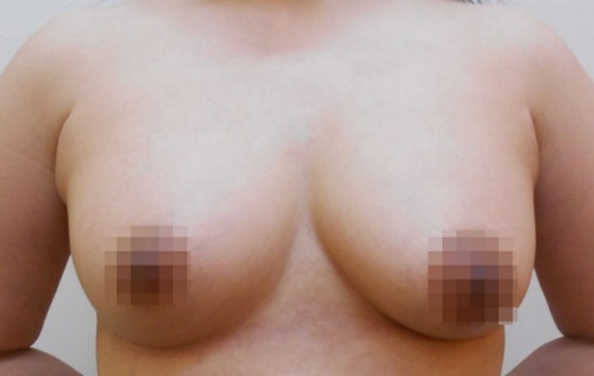 豊胸術の症例写真一覧