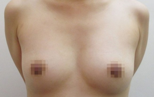 豊胸術の症例写真一覧
