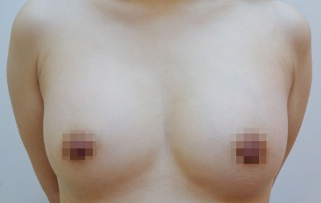 豊胸術の症例写真一覧
