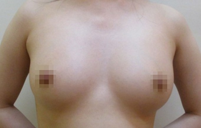 豊胸術の症例写真一覧