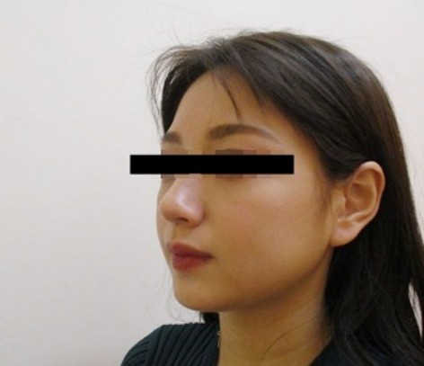 脂肪吸引の症例写真一覧