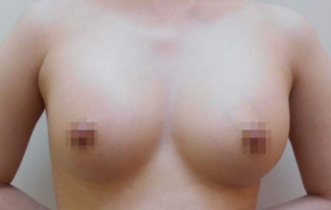 豊胸術の症例写真一覧