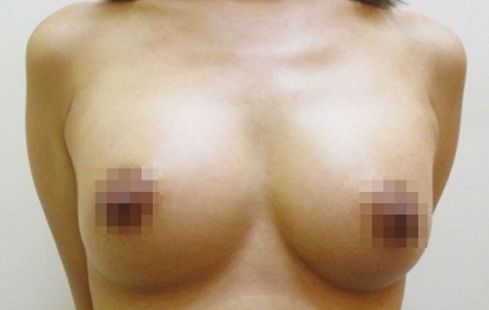 豊胸術の症例写真一覧