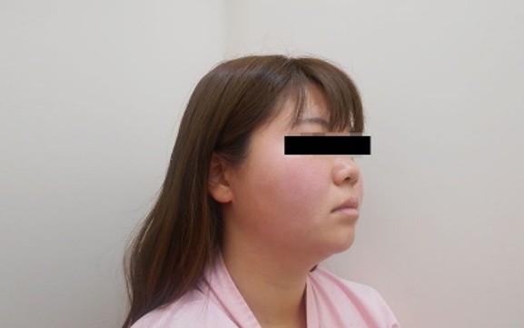 脂肪吸引の症例写真一覧