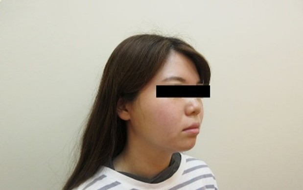 脂肪吸引の症例写真一覧