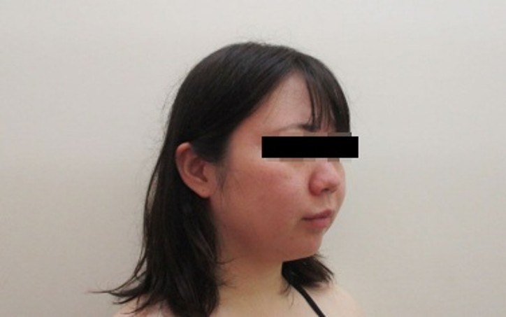 脂肪吸引の症例写真一覧