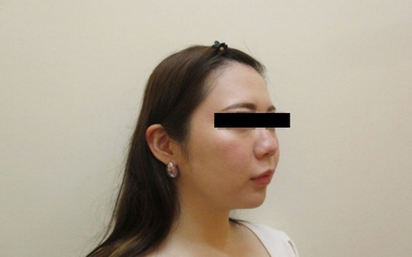 脂肪吸引の症例写真一覧