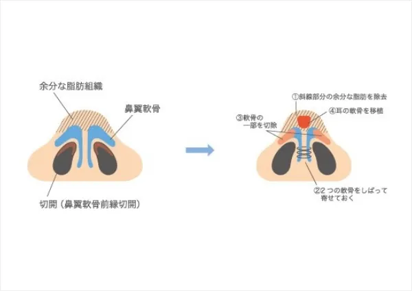 手術方法