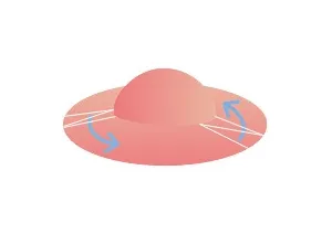 陥没乳頭の手術方法 軽度の場合