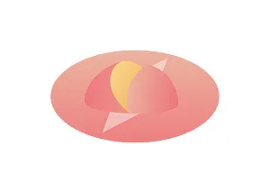 陥没乳頭の手術方法 重度の場合