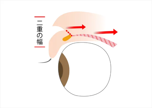 瞼板が引きあがり二重に