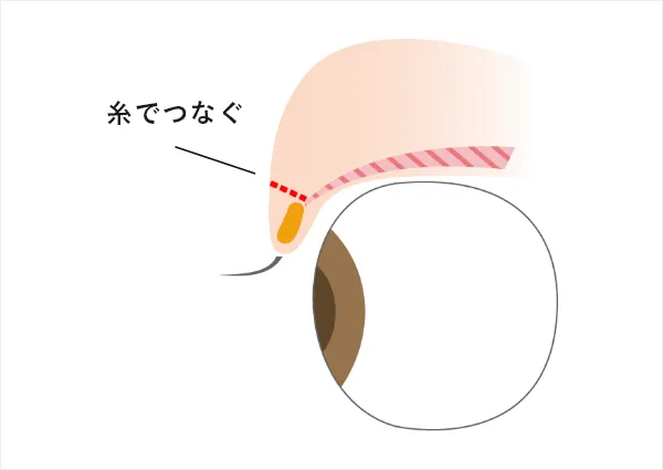 切らずに二重をつくる埋没法