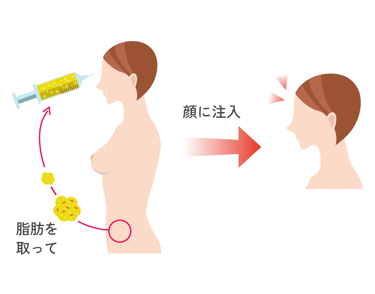 顔の脂肪注入（ほうれい線・額の丸み・頬コケ・顎先・クマ）