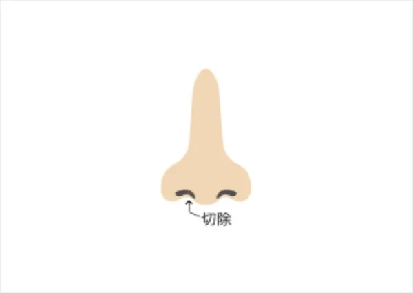プロテーゼ挿入手術