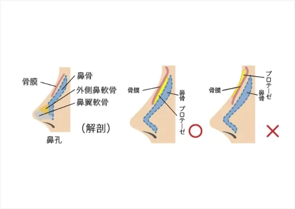 プロテーゼの挿入位置