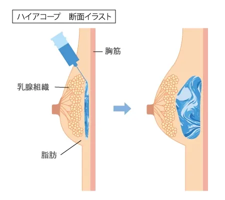 どんな豊胸術？