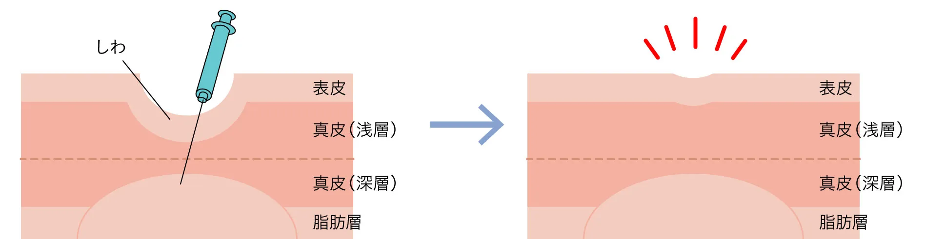 正しい注入方法