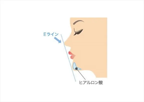 顎（Ｅラインの改善）へのヒアルロン酸注射