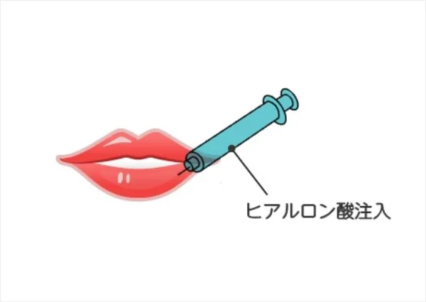 唇へのヒアルロン酸注射