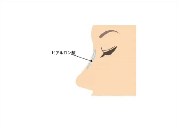 鼻へのヒアルロン酸注射