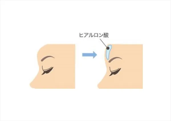 額へのヒアルロン酸注射