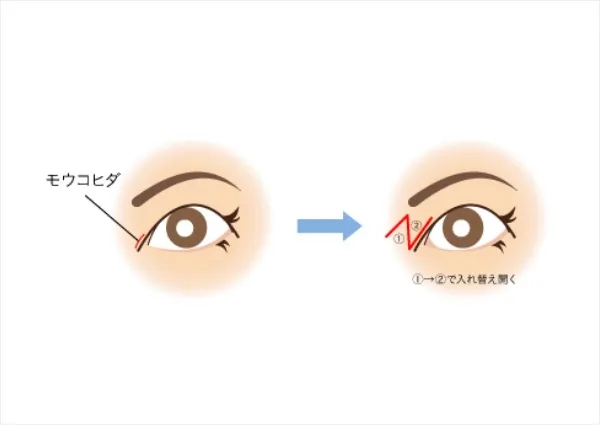 目頭切開の手術について