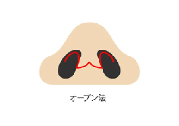 オープン法