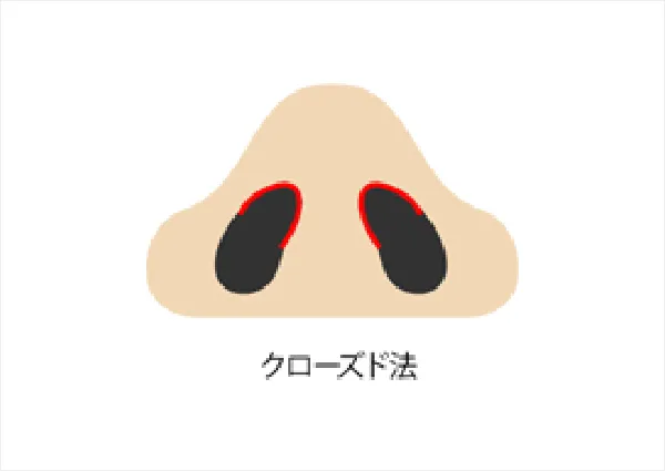 クローズド法