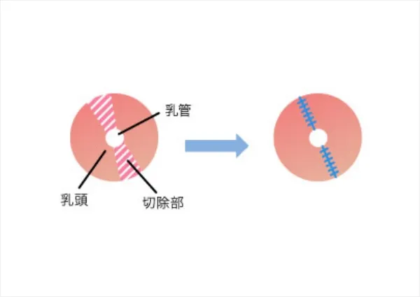 乳頭の直径（大きさ）を小さくする場合