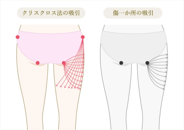 例　太もも外側の吸引