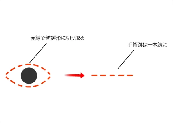 赤線で紡錘形に切り取る　手術跡は一本線に