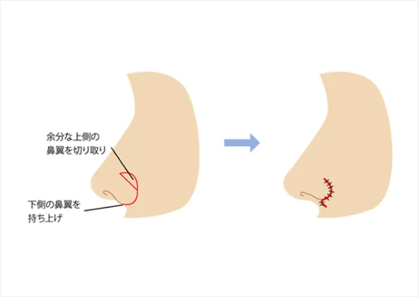 手術方法