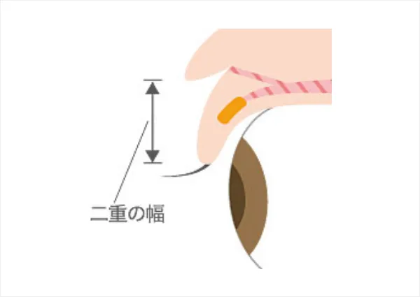 皮膚の引き上げで二重に